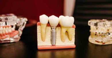 Unlocking the Secrets of Dental Implants: A Comprehensive Guide